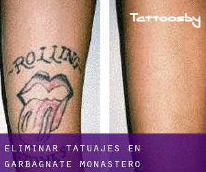 Eliminar tatuajes en Garbagnate Monastero