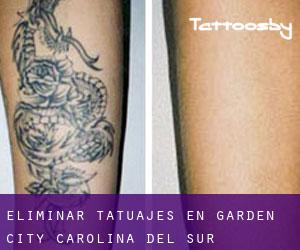 Eliminar tatuajes en Garden City (Carolina del Sur)