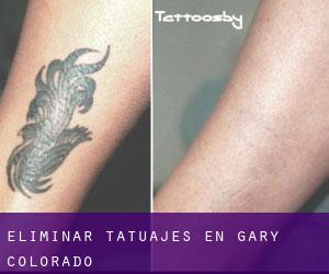 Eliminar tatuajes en Gary (Colorado)
