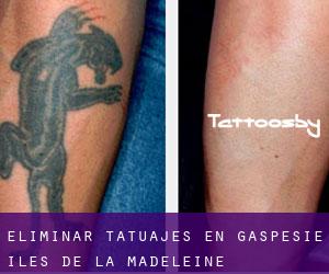 Eliminar tatuajes en Gaspésie-Îles-de-la-Madeleine