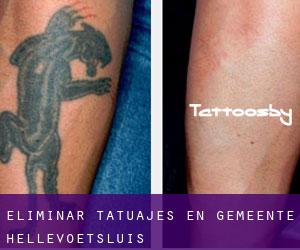 Eliminar tatuajes en Gemeente Hellevoetsluis