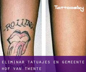 Eliminar tatuajes en Gemeente Hof van Twente