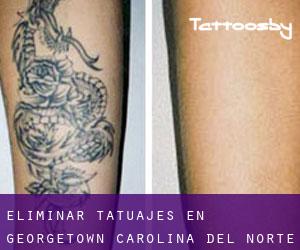 Eliminar tatuajes en Georgetown (Carolina del Norte)
