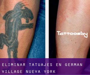Eliminar tatuajes en German Village (Nueva York)