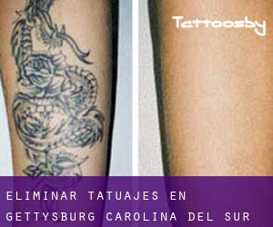 Eliminar tatuajes en Gettysburg (Carolina del Sur)