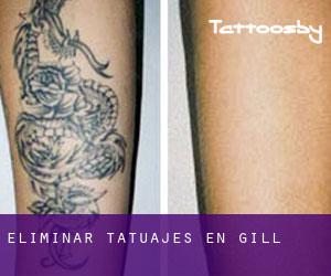 Eliminar tatuajes en Gill