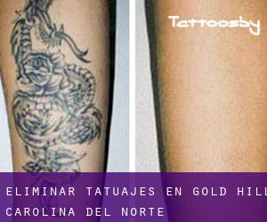 Eliminar tatuajes en Gold Hill (Carolina del Norte)