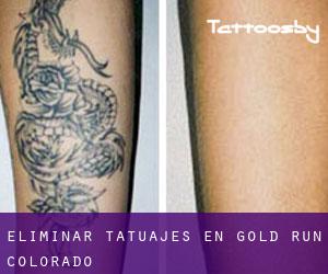 Eliminar tatuajes en Gold Run (Colorado)