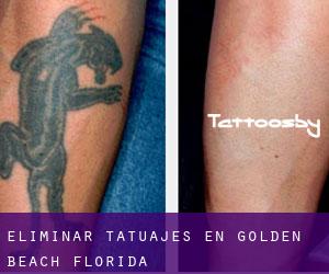 Eliminar tatuajes en Golden Beach (Florida)