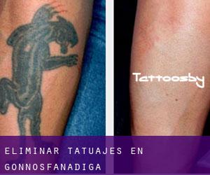 Eliminar tatuajes en Gonnosfanadiga