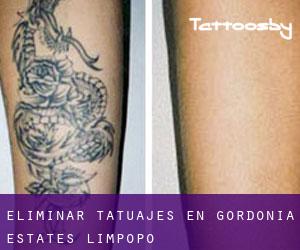 Eliminar tatuajes en Gordonia Estates (Limpopo)