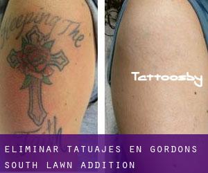 Eliminar tatuajes en Gordons South Lawn Addition