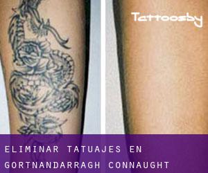 Eliminar tatuajes en Gortnandarragh (Connaught)