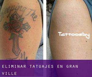 Eliminar tatuajes en Gran-ville
