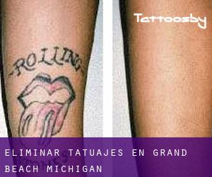 Eliminar tatuajes en Grand Beach (Michigan)