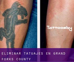 Eliminar tatuajes en Grand Forks County