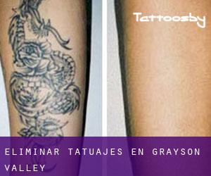 Eliminar tatuajes en Grayson Valley
