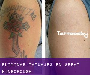 Eliminar tatuajes en Great Finborough