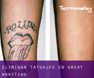 Eliminar tatuajes en Great Wratting