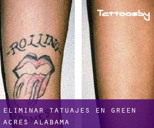 Eliminar tatuajes en Green Acres (Alabama)