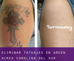 Eliminar tatuajes en Green Acres (Carolina del Sur)
