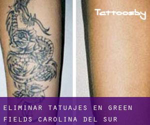 Eliminar tatuajes en Green Fields (Carolina del Sur)