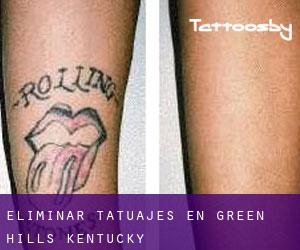 Eliminar tatuajes en Green Hills (Kentucky)