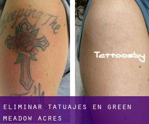 Eliminar tatuajes en Green Meadow Acres