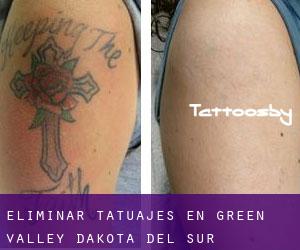 Eliminar tatuajes en Green Valley (Dakota del Sur)