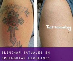 Eliminar tatuajes en Greenbriar Highlands