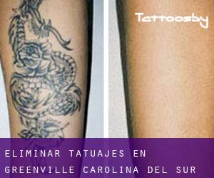 Eliminar tatuajes en Greenville (Carolina del Sur)