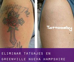 Eliminar tatuajes en Greenville (Nueva Hampshire)