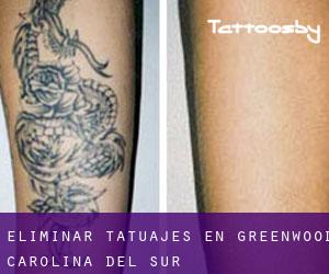 Eliminar tatuajes en Greenwood (Carolina del Sur)