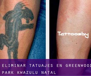 Eliminar tatuajes en Greenwood Park (KwaZulu-Natal)