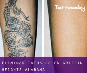 Eliminar tatuajes en Griffin Heights (Alabama)