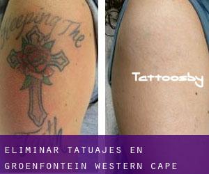 Eliminar tatuajes en Groenfontein (Western Cape)