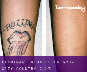 Eliminar tatuajes en Grove City Country Club
