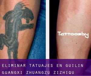 Eliminar tatuajes en Guilin (Guangxi Zhuangzu Zizhiqu)