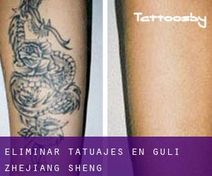 Eliminar tatuajes en Guli (Zhejiang Sheng)