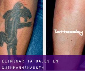 Eliminar tatuajes en Guthmannshausen
