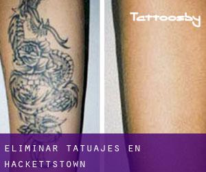 Eliminar tatuajes en Hackettstown