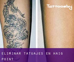 Eliminar tatuajes en Haig Point