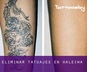 Eliminar tatuajes en Hale‘iwa