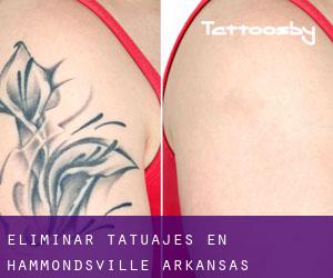 Eliminar tatuajes en Hammondsville (Arkansas)