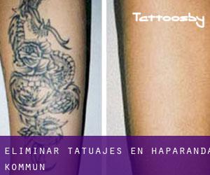 Eliminar tatuajes en Haparanda Kommun