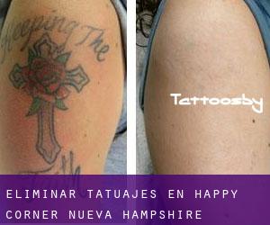 Eliminar tatuajes en Happy Corner (Nueva Hampshire)
