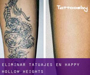 Eliminar tatuajes en Happy Hollow Heights