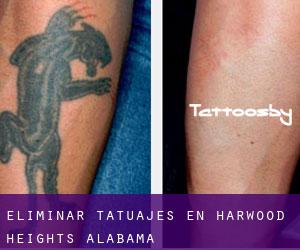 Eliminar tatuajes en Harwood Heights (Alabama)