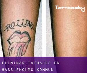 Eliminar tatuajes en Hässleholms Kommun