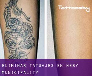 Eliminar tatuajes en Heby Municipality